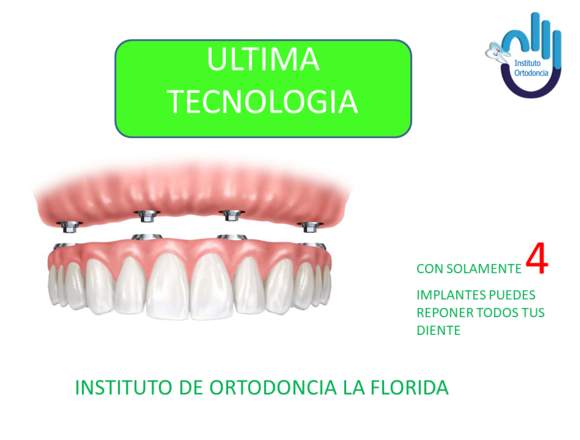 Implantes dentales en la Florida