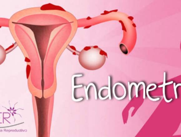 Clínica Gynemer ENDOMETRIOSIS 