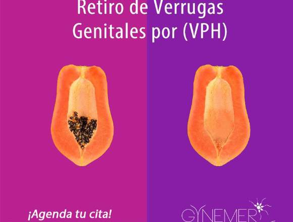 Clínica Gynemer Retiro de verrugas