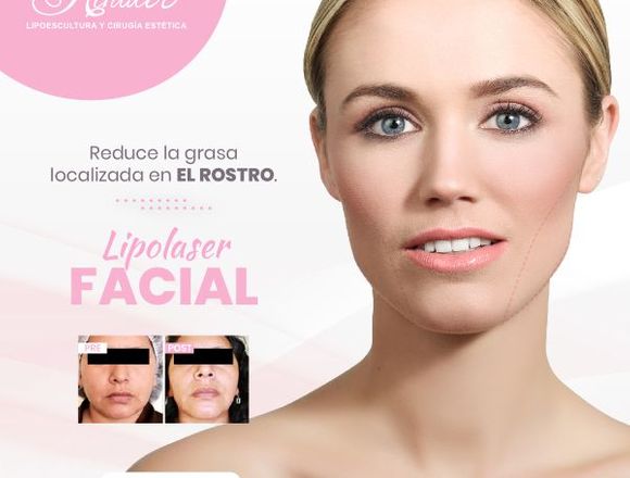 Rostro más delgado‎ con lipolaser