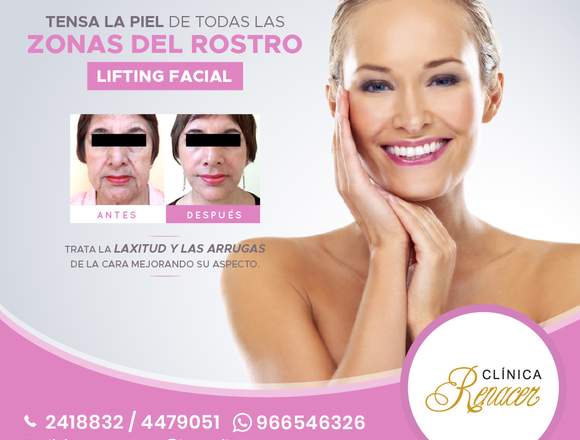 Lifting o estiramiento facial - Clínica Renacer