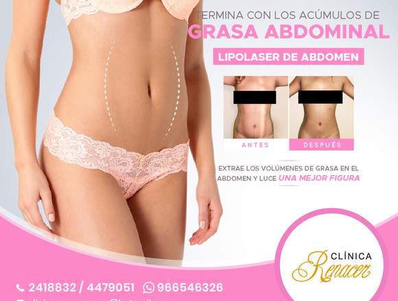 Abdomen plano con Lipolaser - Clínica Renacer