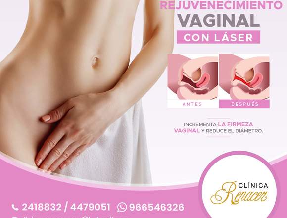 Cirugía Vaginal Láser - Clínica Renacer