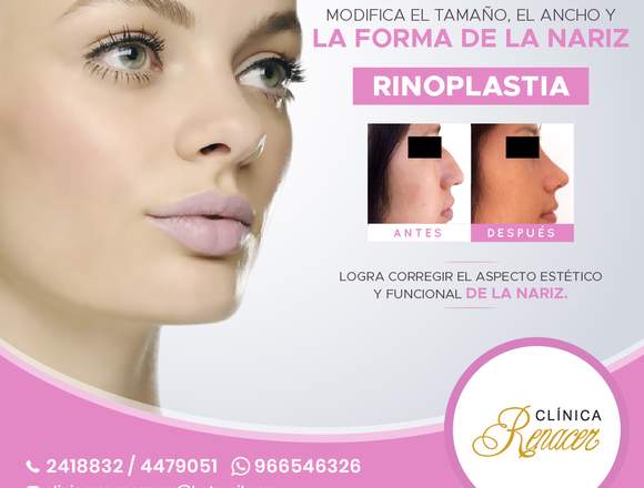 Rinoplastia - Clínica Renacer