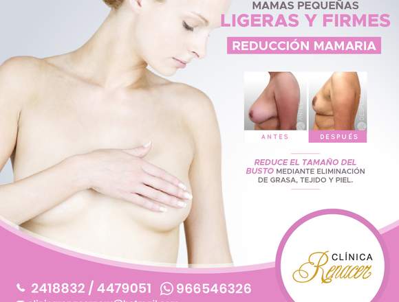 Cirugía de reducción mamaria - Clínica Renacer