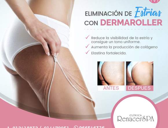 ELIMINA LAS ESTRÍAS-CLÍNICA RENACERSPA