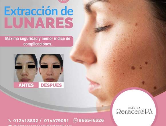 Extracción de lunares - ClinicaRenacerSpa