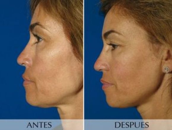 Rejuvenecimiento facial