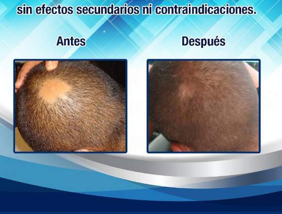 Tratamiento regenerador de cabello p/hombres