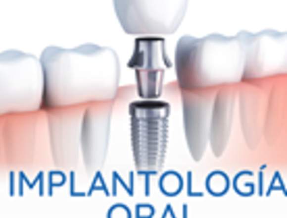 Implantacion Oral Loja Stoma Dental Studio