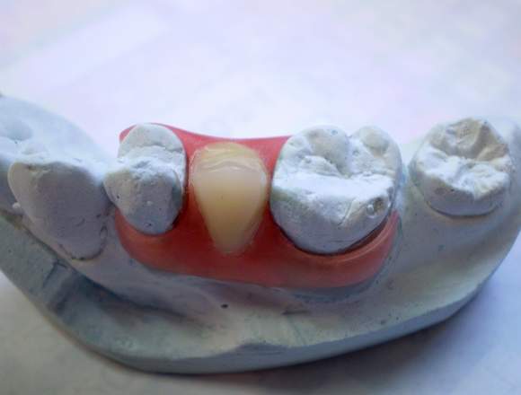 PRÓTESIS DENTAL SEMI-FELXIBLE AMERICANA 