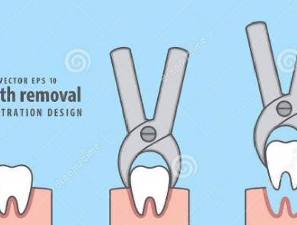 CIRUGÍA DE EXTRACCIÓNES DENTALES