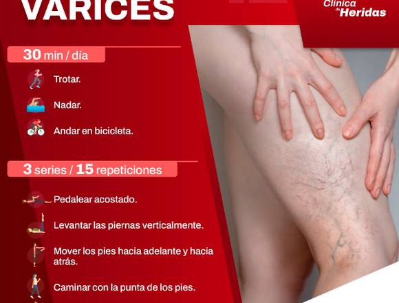 ¿Problemas de varices?