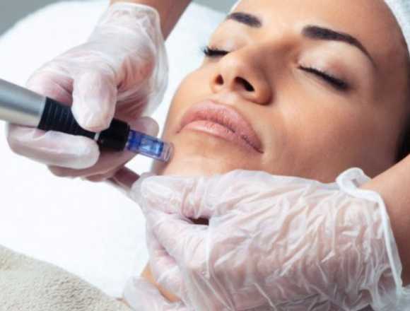 Dermapen facial en Salones Carolinas: