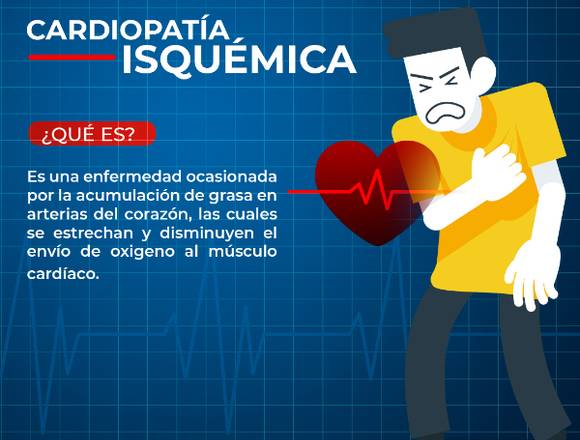 Cardiopatía Isquémica