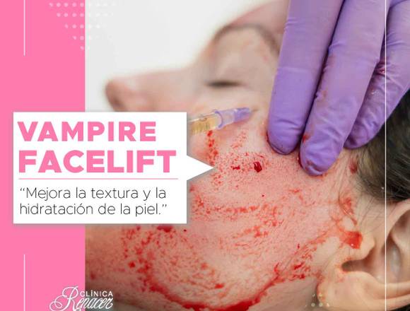 Vampire facelift Clinica Renacer
