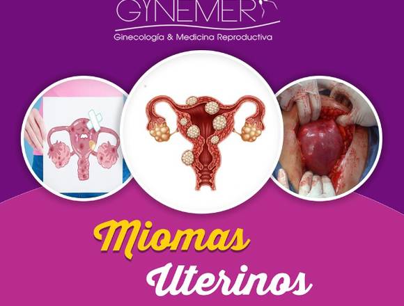 Los miomas uterinos !