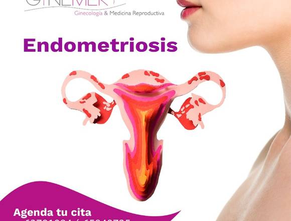 ¡Endometriosis! Gynemer