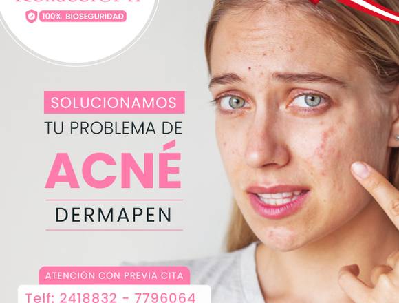 Elimina las marcas del acné