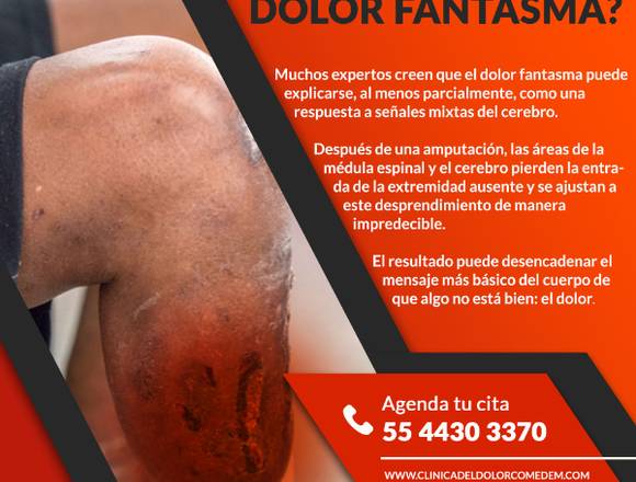 ¿Qué causa el Dolor Fantasma?