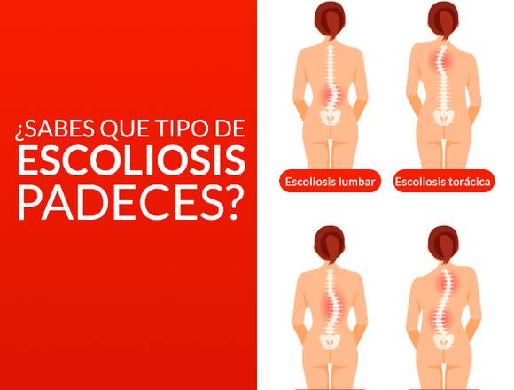 ¿Qué tipo de escoliosis padeces?