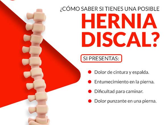 ¿Cómo saber si tienes una posible hernia discal?