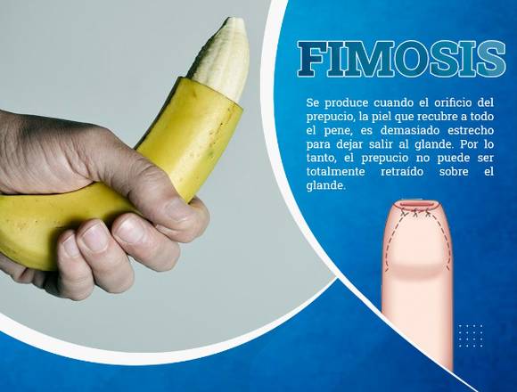 Fimosis              