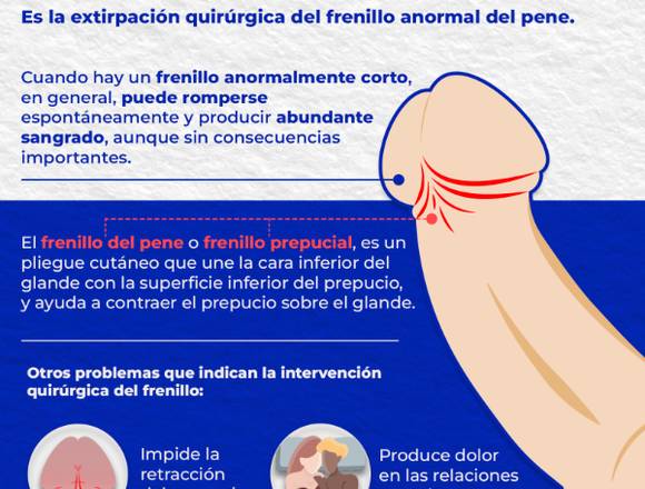 Realízate la frenulectomia peneana 