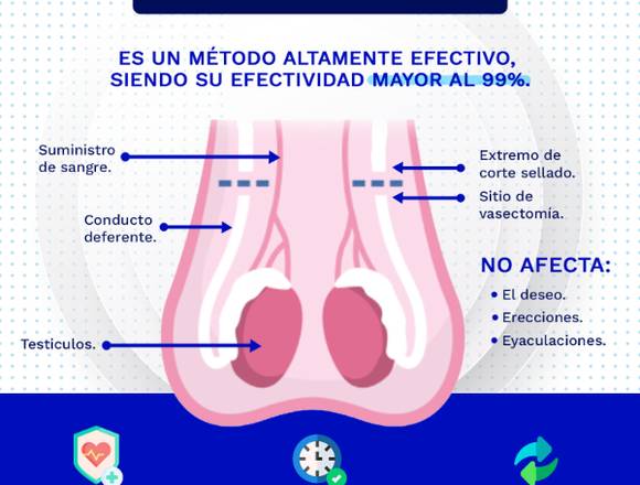 Vasectomía sin bisturí 