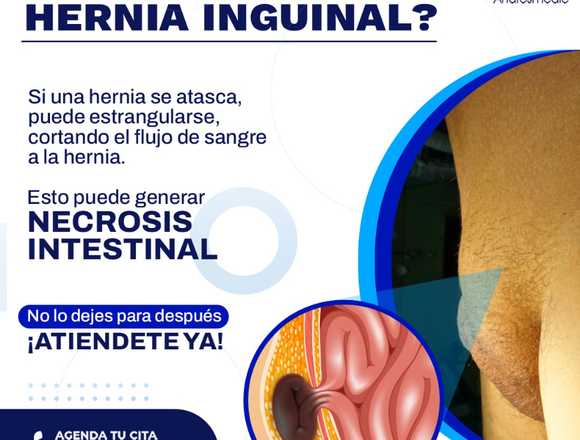 La hernia inguinal   