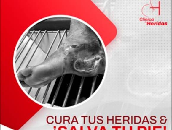 Cuida tu herida ¡Salva tu pie! 