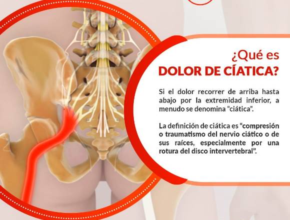 ¿Que es el dolor de Cíatica?