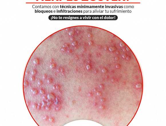 ¿El dolor te consume a causa del Herpes Zoster?