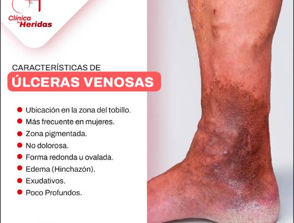 ¿Tienes Ulceras Venosas? 