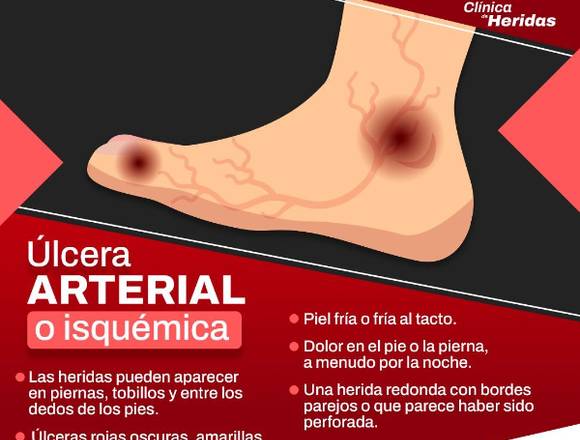 ¿Tienes úlceras arteriales?