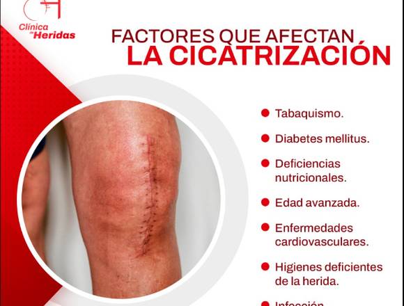 ¿Cómo esta cicatrizando tu herida? 