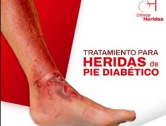 Heridas de pie diabético 