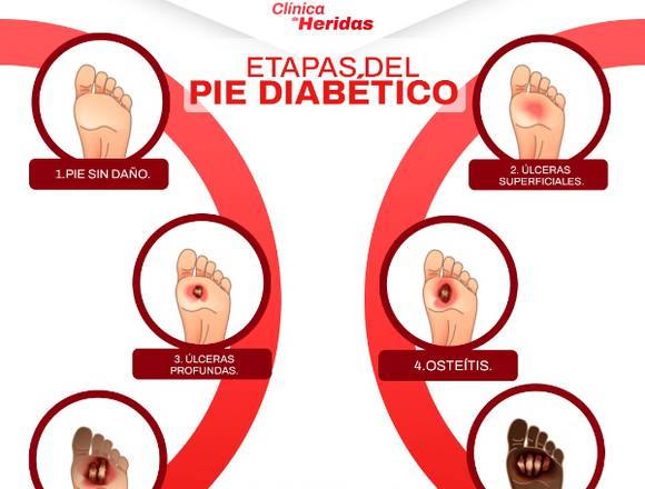 ¿Eres Diabético y tienes una herida? 