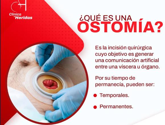 ¿Qué es una Ostomía? 