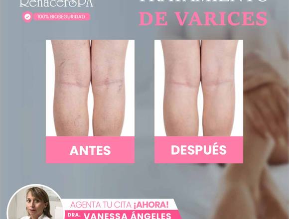 Diles adiós a las varices 