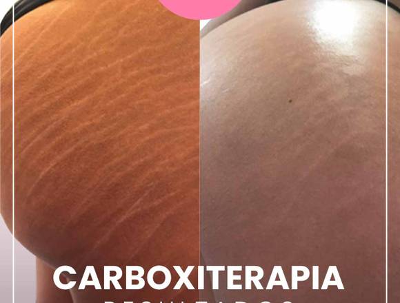 carboxiterapia - medicina estetica