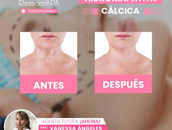 Relleno facial Hidroxiapatita Cálcica