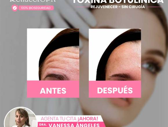 Botox – Rejuvenecimiento Facial