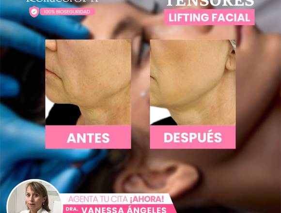 hilos tensores  lifting facial