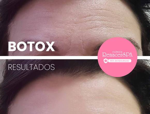 Botox – facial rostro joven