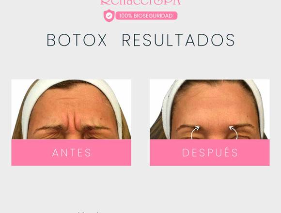 Obtén un rostro joven – Botox