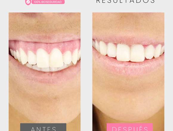 Botox - Sonrisa gingival