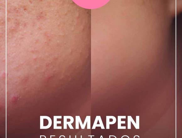 Dermapen - Lápiz mágico 