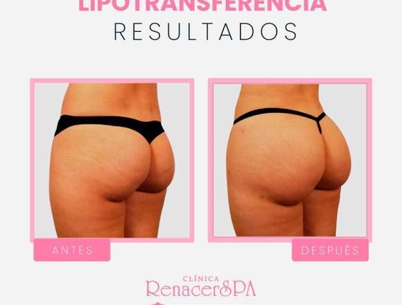 Lipotransferencia de glúteos