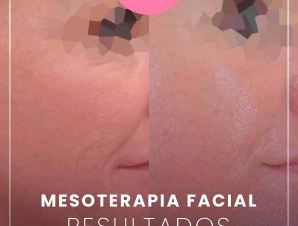 Mesoterapia facial - Medicina Estética